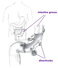 Diverticulose de Intestino Grosso, Doença Diverticular e Diverticulite